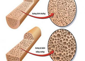 Những biểu hiện thiếu canxi ai cũng cần phải biết?