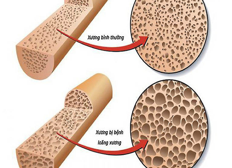 biểu hiện thiếu canxi